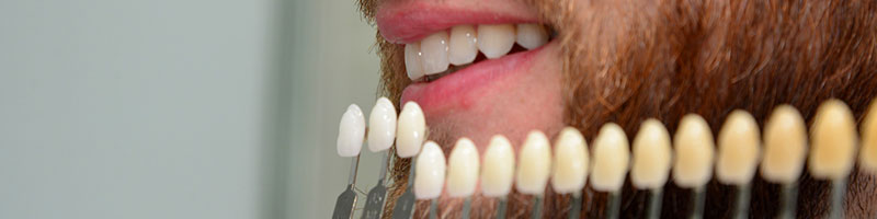 Clareamento dental
